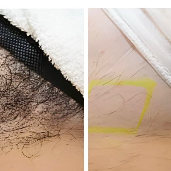 Brazilian Laser Hair Removal at The Gleaux Lab/Charmed Beauty, LLC in West Monroe, LA